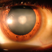 300px-Cataract_in_human_eye